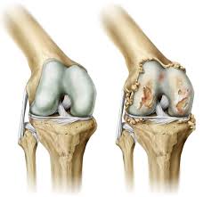 Desgaste de Rodilla