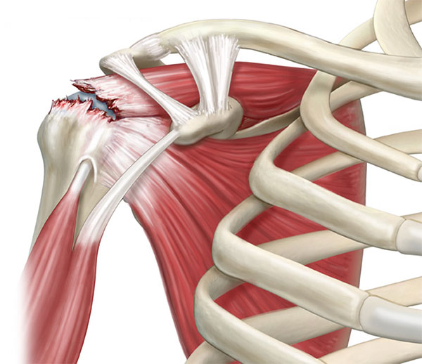 Lesiones de Manguito Rotador